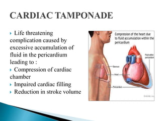  Life threatening
complication caused by
excessive accumulation of
fluid in the pericardium
leading to :
 Compression of cardiac
chamber
 Impaired cardiac filling
 Reduction in stroke volume
 