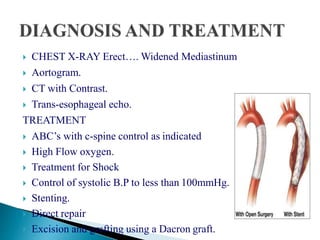  CHEST X-RAY Erect…. Widened Mediastinum
 Aortogram.
 CT with Contrast.
 Trans-esophageal echo.
TREATMENT
 ABC’s with c-spine control as indicated
 High Flow oxygen.
 Treatment for Shock
 Control of systolic B.P to less than 100mmHg.
 Stenting.
 Direct repair
 Excision and grafting using a Dacron graft.
 
