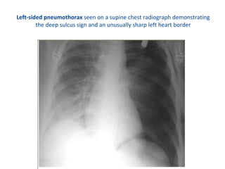 Chest trauma | PPT