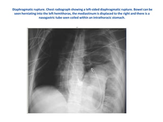 Chest trauma | PPT