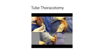 Tube Thoracotomy
 