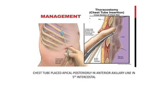 CHEST TUBE PLACED APICAL-POSTERIORLY IN ANTERIOR AXILLARY LINE IN
5th INTERCOSTAL
 