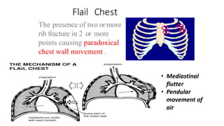 Flail Chest
The presence of two ormore
rib fracture in 2 or more
points causing paradoxical
chest wall movement .
• Mediastinal
flutter
• Pendular
movement of
air
 