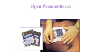 Open Pneumothorax
• Petroleum Gauze can also be used to
seal a sucking chest wound.
 