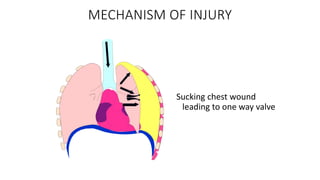 MECHANISM OF INJURY
Sucking chest wound
leading to one way valve
 