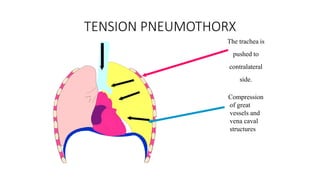 The trachea is
pushed to
contralateral
side.
Compression
of great
vessels and
vena caval
structures
TENSION PNEUMOTHORX
 