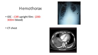 Hemothorax
• IOC : CXR upright film: (200-
300ml blood)
• CT chest
 