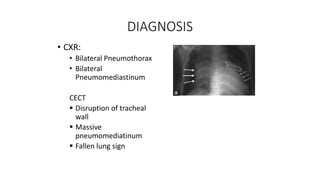 DIAGNOSIS
• CXR:
• Bilateral Pneumothorax
• Bilateral
Pneumomediastinum
CECT
 Disruption of tracheal
wall
 Massive
pneumomediatinum
 Fallen lung sign
 