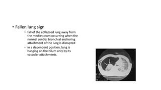 • Fallen lung sign
• fall of the collapsed lung away from
the mediastinum occurring when the
normal central bronchial anchoring
attachment of the lung is disrupted
• in a dependent position, lung is
hanging on the hilum only by its
vascular attachments.
 