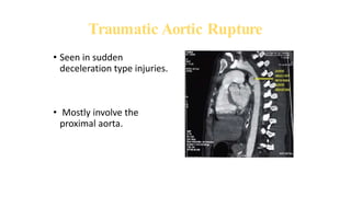 Traumatic Aortic Rupture
• Seen in sudden
deceleration type injuries.
• Mostly involve the
proximal aorta.
 