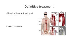 Definitive treatment
• Repair with or without graft
• Stent placement
 