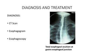 DIAGNOSIS AND TREATMENT
DIAGNOSIS:
• CT Scan
• Esophagogram
• Esophagoscopy
Total esophageal avulsion at
gastro esophageal junction
 