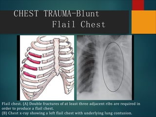 chest trauma.pdf
