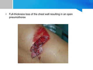 • Full-thickness loss of the chest wall resulting in an open
pneumothorax
 