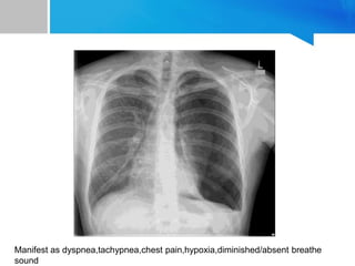 Manifest as dyspnea,tachypnea,chest pain,hypoxia,diminished/absent breathe
sound
 