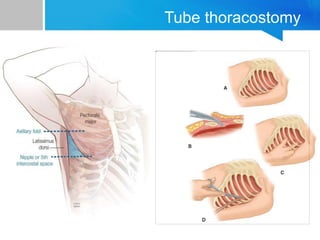 Tube thoracostomy
 