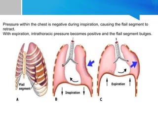 Pressure within the chest is negative during inspiration, causing the flail segment to
retract.
With expiration, intrathoracic pressure becomes positive and the flail segment bulges.
 