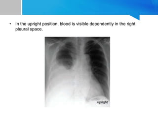 • In the upright position, blood is visible dependently in the right
pleural space.
 
