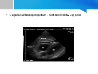 • Diagnosis of hemopericardium - best achieved by usg scan
 
