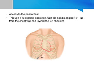 • Access to the pericardium
• Through a subxiphoid approach, with the needle angled 45° up
from the chest wall and toward the left shoulder.
 