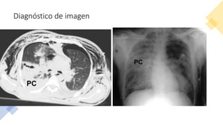 Diagnóstico de imagen
• Infradiagnóstico Rx
• ~ 1000 pacientes; TAC –
100% contusiones
pulmonares vs 38% Rx.*
• Diagnóstico temprano
 volumen total
contusion.
 