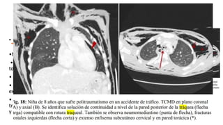 Laceración
traqueal
• Suele tener trayecto vertical
(perpendicular a los anillos traqueales).
•Neumomediastino.
• Enfisema en partes blandas, cervical y
torácico.
• ~Neumotórax.
• Malposición tubo endotraqueal  se
extiende a través defecto traqueal.
• ~Defecto en anillos cartilaginosos -
tráquea,  tracto - aire entre luz de tráquea
y aire paratraqueal o deformidad traqueal.
 