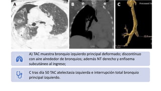 A) TAC muestra bronquio izquierdo principal deformado; discontínuo
con aire alrededor de bronquios; además NT derecho y enfisema
subcutáneo al ingreso;
C tras día 50 TAC atelectasia izquierda e interrupción total bronquio
principal izquierdo.
 