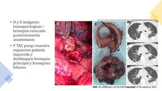 • D y E imágenes
transquirúrgicas –
bronquio resecado
posteriormente
anastomosis
• F TAC posqx muestra
expansion pulmón
izquierdo y
desbloqueo bronquio
principal y bronquios
lobares
 