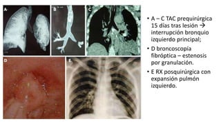• A – C TAC prequirúrgica
15 días tras lesión 
interrupción bronquio
izquierdo principal;
• D broncoscopía
fibróptica – estenosis
por granulación.
• E RX posquirúrgica con
expansión pulmón
izquierdo.
 