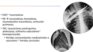 • FAST ~neumotórax
• RX  neumotórax; hemotórax,
neumatocéles traumáticos, contusión
pulmonar;
• TAC: laceraciones parénquima;
atelectasia, enfisema subcutáneo~
hemopericardio.
• Heridas concomitantes mediastinales o
vasculares ~ heridas cervicales
 