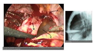 • Toracostomía  diagnóstica /
terapéutica.
• Toracoscopía videoasistida;
• Evaluación parénquima, mediastino,
diafragma ~ tratamiento.
 