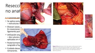 Resección lobar
no anatómica.
• ~ Lesiones extensas;
• Se aplica compresión digital/ clamp vascular
– estructuras hiliares;
• Disecan vasos;
En resecciones lóbulo inferior  incide
ligamento pulmonar.
• Utilización engrapadora; antes de activación
– dos suturas p/ fijación o fórceps Allis
aplicadas en muñón  prevenir retracción;
• Posteriormente línea de sutura – control
sangrado o fuga aérea.
• Cuidado desvascularización parénquima
remanente.
 