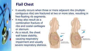Two Adject Ribs Chest Trauma - Medical and Surgical Treatment.pptx