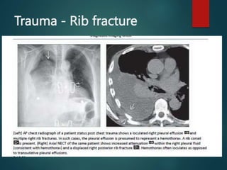 CHEST trauma theoritical lecture 1st term.pptx