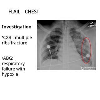 Flail Rips chest trauma Critical Care topic for medical | PPTX