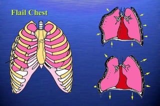 Chest_Trauma.pdf……………………………,…….,……………….. | PDF