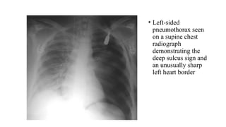 Chest Trauma hgfhkhlrduihrwjjtjhrtjhdh.pptx