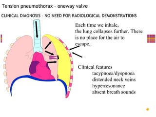 Tension pneumothorax – oneway valve
CLINICAL DIAGNOSIS – NO NEED FOR RADIOLOGICAL DEMONSTRATIONS

                                Each time we inhale,
                                the lung collapses further. There
                                is no place for the air to
                                escape..



                                 Clinical features
                                        tacypnoea/dyspnoea
                                        distended neck veins
                                        hyperresonance
                                        absent breath sounds
 