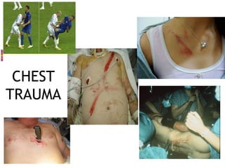 CHEST
TRAUMA
 