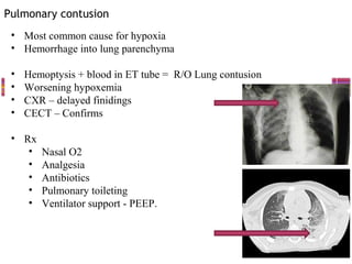 Pulmonary contusion
 • Most common cause for hypoxia
 • Hemorrhage into lung parenchyma

 •   Hemoptysis + blood in ET tube = R/O Lung contusion
 •   Worsening hypoxemia
 •   CXR – delayed finidings
 •   CECT – Confirms

 • Rx
    •   Nasal O2
    •   Analgesia
    •   Antibiotics
    •   Pulmonary toileting
    •   Ventilator support - PEEP.
 