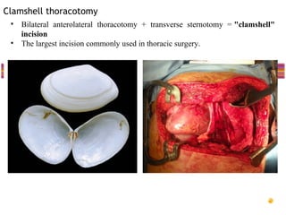 Clamshell thoracotomy
 • Bilateral anterolateral thoracotomy + transverse sternotomy = "clamshell"
   incision
 • The largest incision commonly used in thoracic surgery.
 