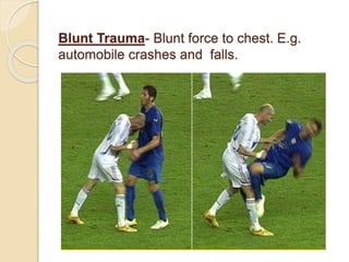 Blunt Trauma- Blunt force to chest. E.g.
automobile crashes and falls.
 