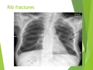chest trauma chest trauma chest trauma 1.ppt