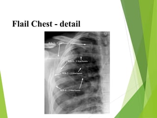 chest trauma chest trauma chest trauma 1.ppt