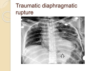 Chest trauma | PPTX