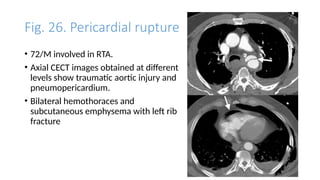 Chest Trauma(2).ppt for master students consumption | PPTX