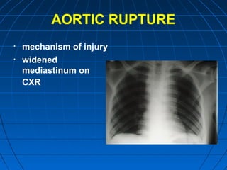 AORTIC RUPTURE
• mechanism of injury
• widened
mediastinum on
CXR
 