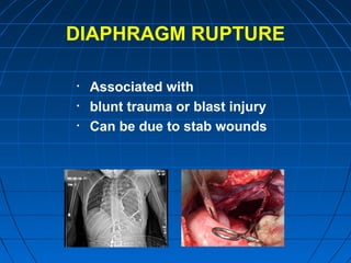 DIAPHRAGM RUPTURE
• Associated with
• blunt trauma or blast injury
• Can be due to stab wounds
 