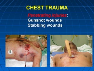 CHEST TRAUMA
Penetrating injuries:
Gunshot wounds
Stabbing wounds
 