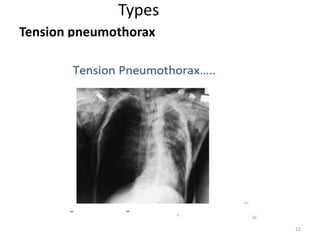 Types
Tension pneumothorax
22
 